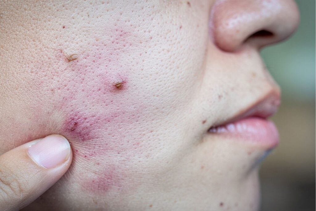 acne na mulher adulta