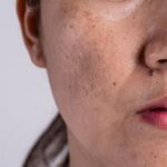 Melasma profundo: novos tratamentos de dentro para fora em 2026