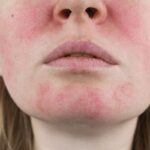 Rosácea e pele sensível: como acalmar a inflamação crônica do rosto
