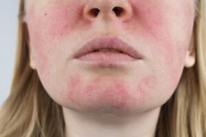 rosacea