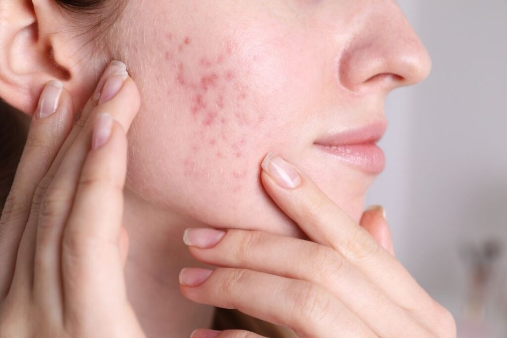 cicatrizes de acne