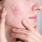 Cicatrizes de acne: tratamentos eficazes para recuperar a textura da pele