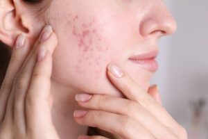 cicatrizes de acne