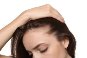 alopecia feminina