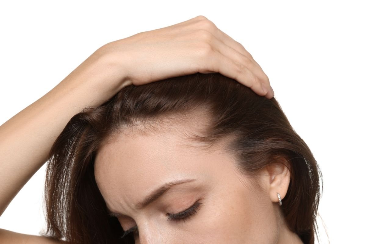 alopecia feminina
