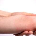 Dermatite atópica: como controlar a inflamação crônica e recuperar o conforto