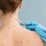 Câncer de pele: como prevenir, identificar e tratar o melanoma e outros tipos